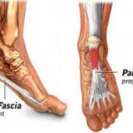 Plantar-Fasciitis-Heel-Spur-or-Heel-Pain..jpg