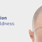 signature18-clinic-haircare_treatments-hair_transplantation.jpg